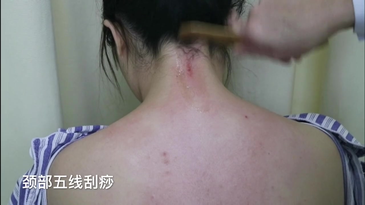 手法视频丨颈部刮痧手法