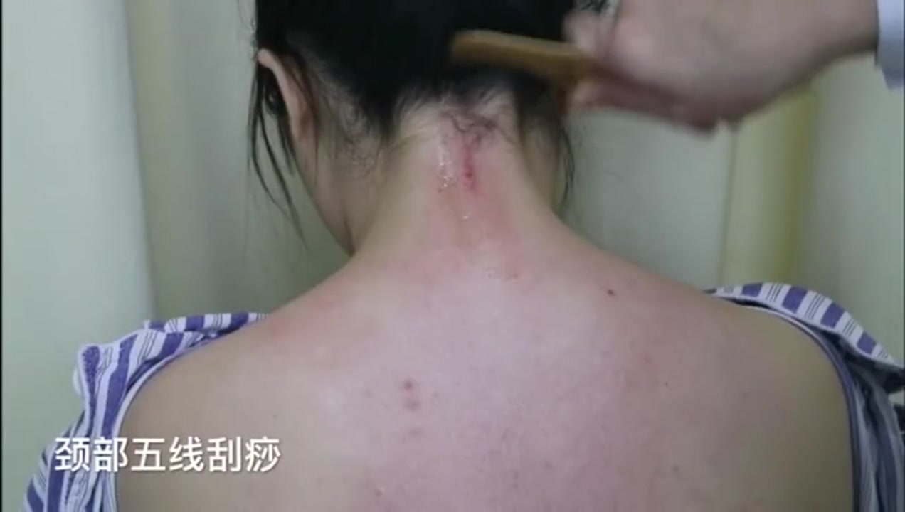 中医刮痧–颈部五线刮痧手法视频